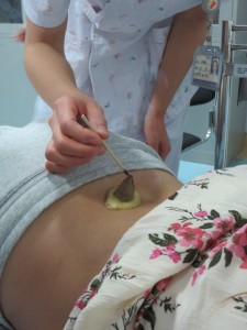 Moxibustion: A small cone of dried herbs is slowly burning on a patient's back. 